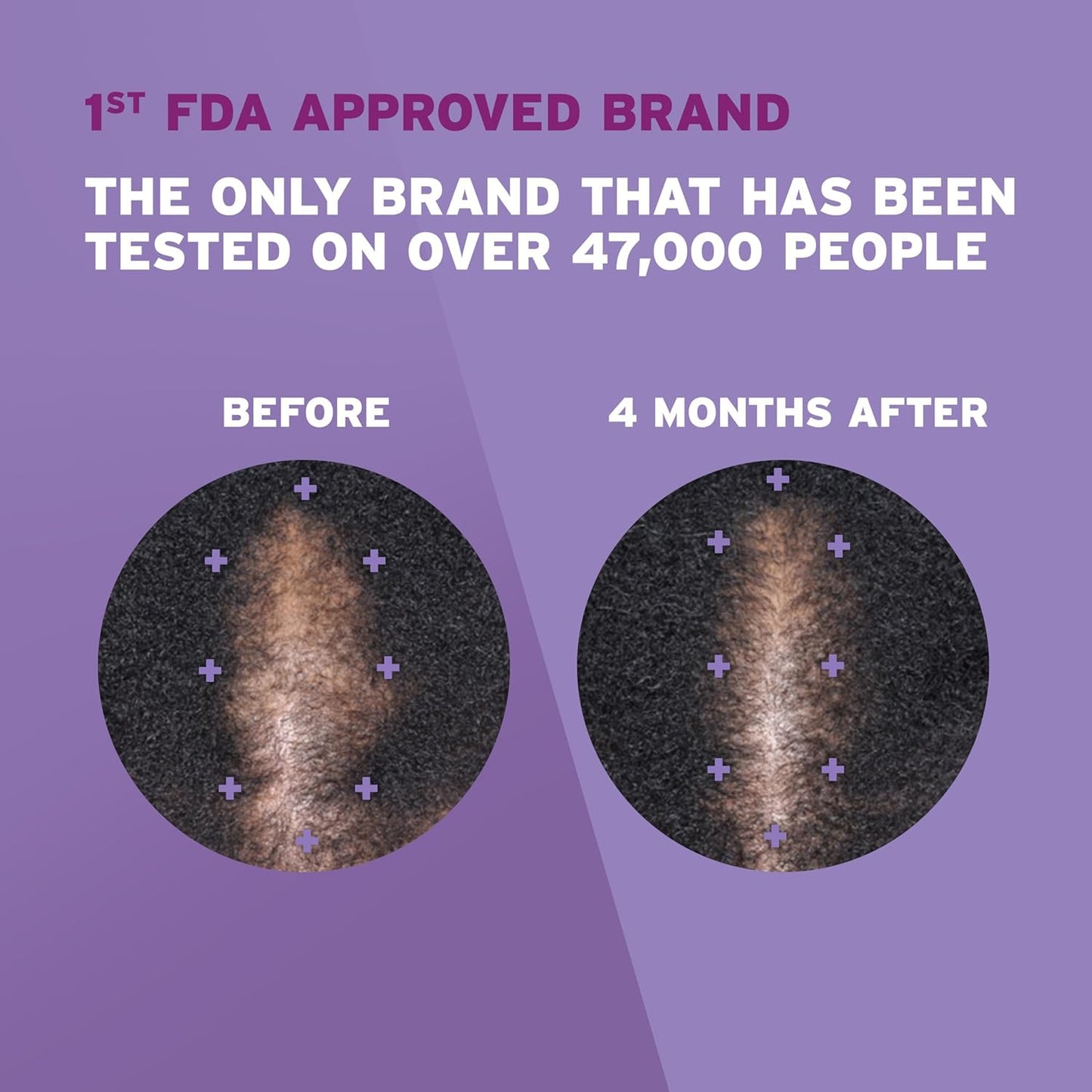 Rogaine 5% Minoxidil Foam